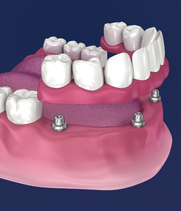 Overdentures (Implant-Supported Dentures)  in Houston Tx